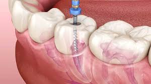 Root Canal Treatment at Supreme Multi-Speciality Dental Centre